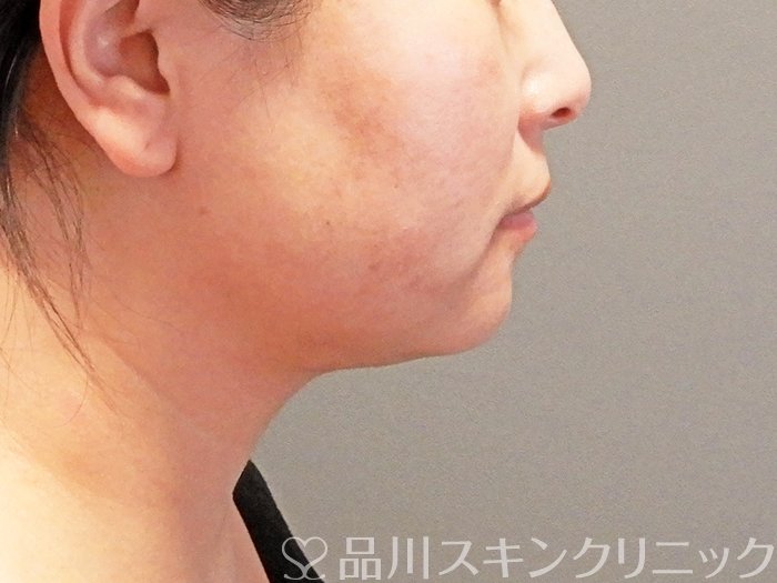 症例NO.63669のAFTER写真