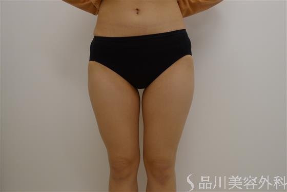 症例NO.35819のAFTER写真