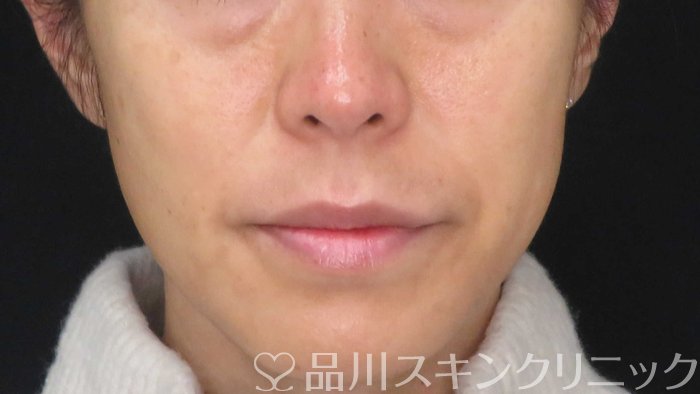 症例NO.71223のBEFORE写真