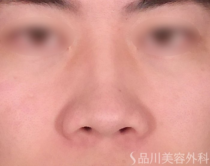 症例NO.69162のBEFORE写真