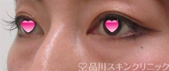 症例NO.41306のBEFORE写真