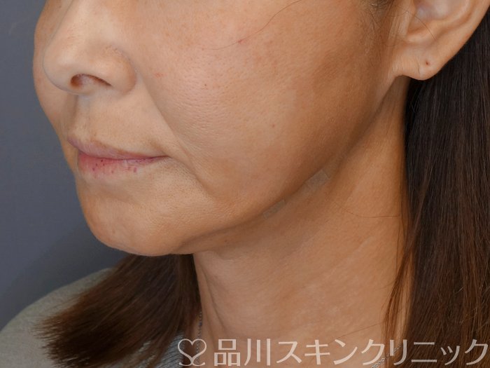 症例NO.71787のAFTER写真