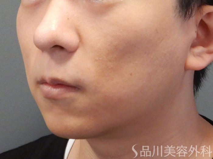 症例NO.73628のAFTER写真