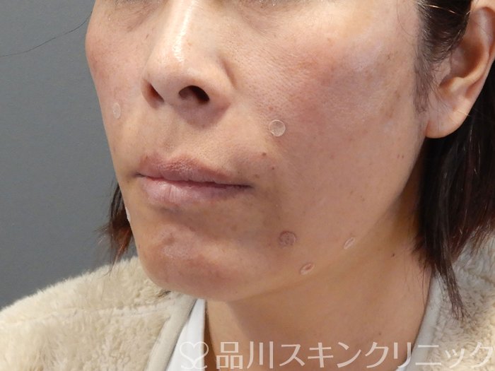 症例NO.69479のAFTER写真