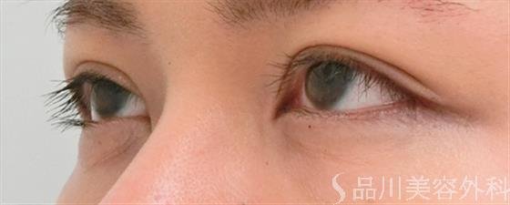 症例NO.25130のAFTER写真