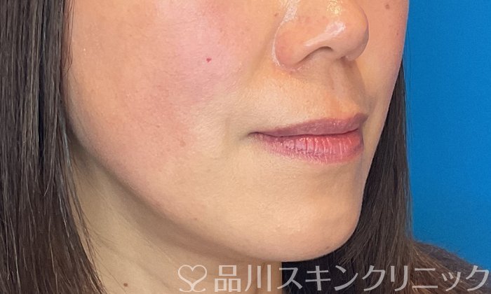 症例NO.74640のAFTER写真