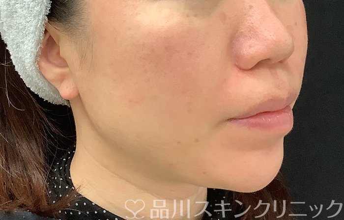 症例NO.69065のAFTER写真