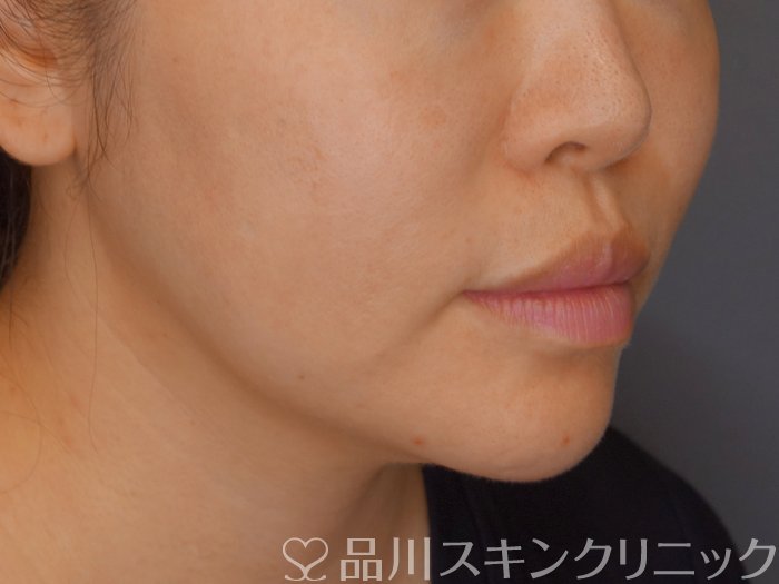 症例NO.71762のBEFORE写真