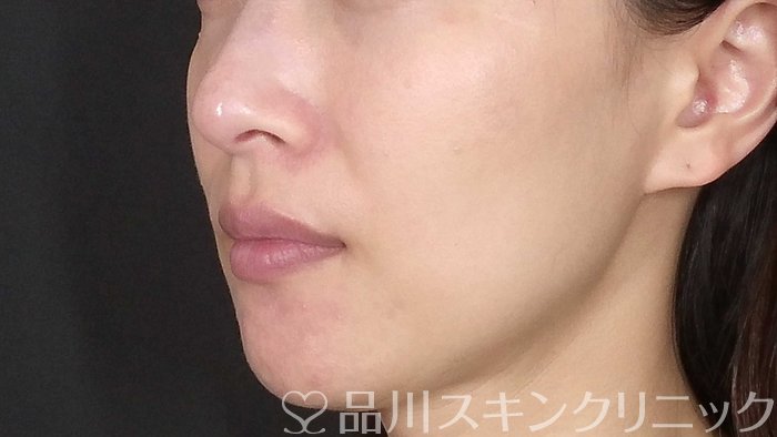 症例NO.71980のBEFORE写真