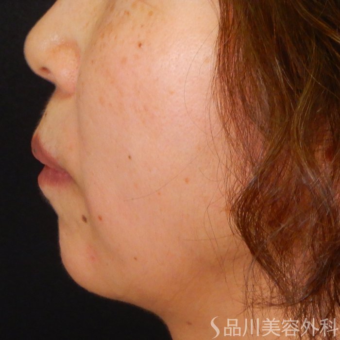 症例NO.68157のAFTER写真