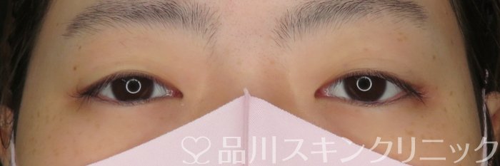 症例NO.68284のBEFORE写真