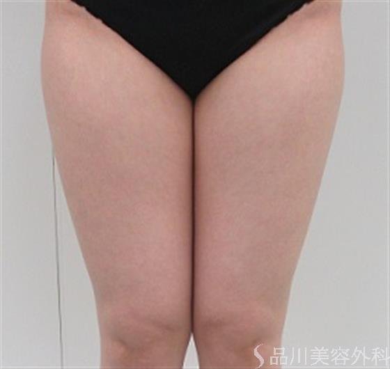症例NO.26525のBEFORE写真