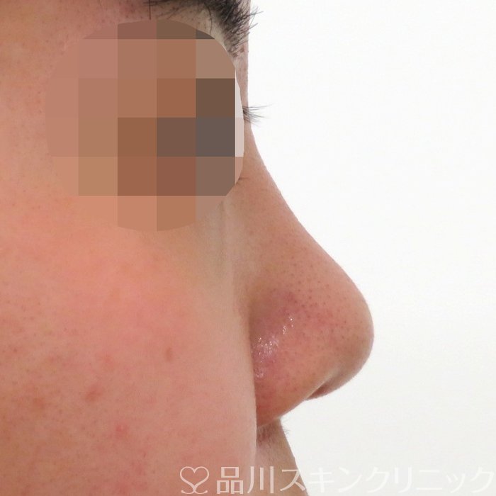 症例NO.70202のBEFORE写真