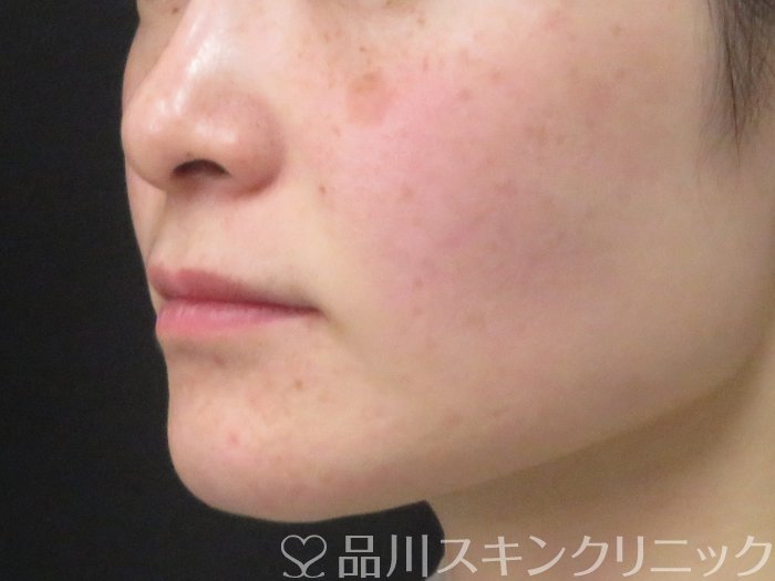 症例NO.74266のBEFORE写真