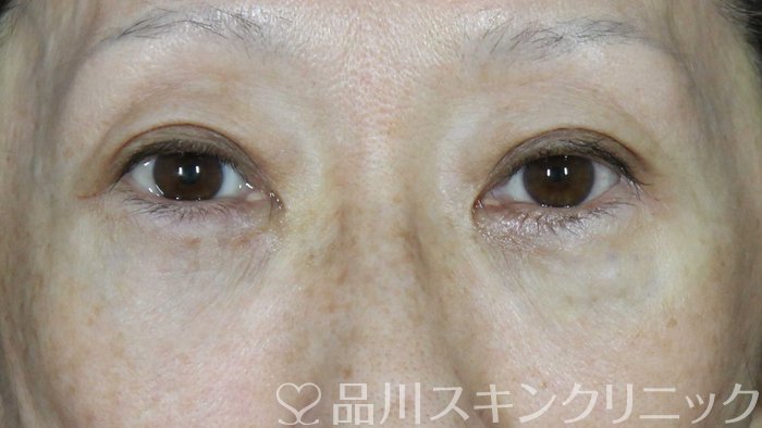 症例NO.72543のAFTER写真