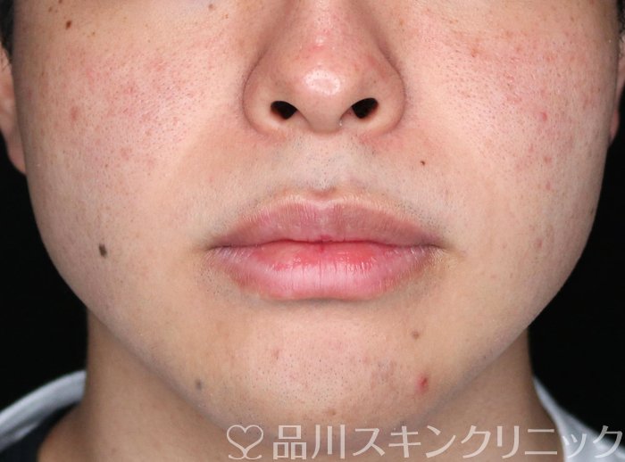 症例NO.72785のBEFORE写真