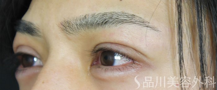 症例NO.70353のAFTER写真