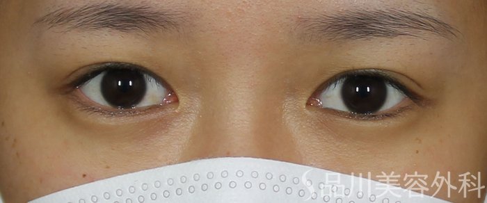 症例NO.69535のBEFORE写真