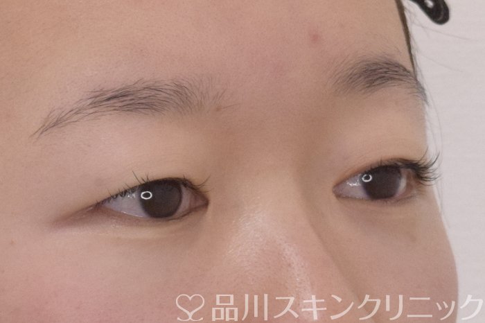 症例NO.69571のBEFORE写真