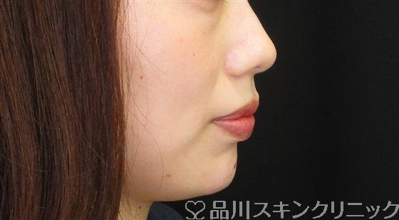 症例NO.61933のBEFORE写真