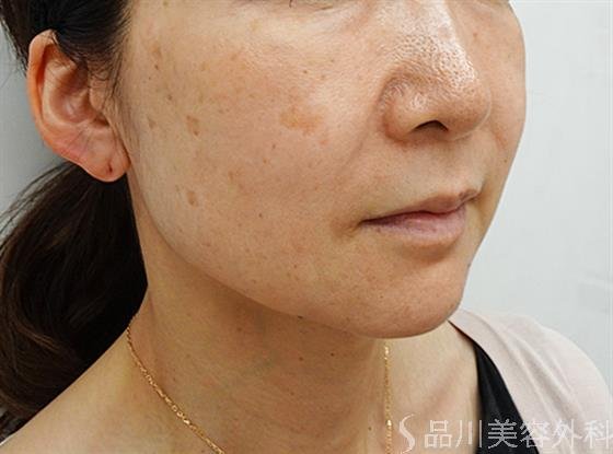 症例NO.44611のBEFORE写真