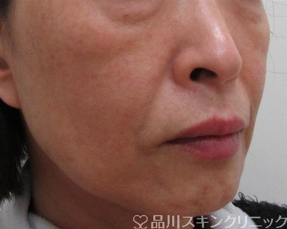 症例NO.33713のBEFORE写真