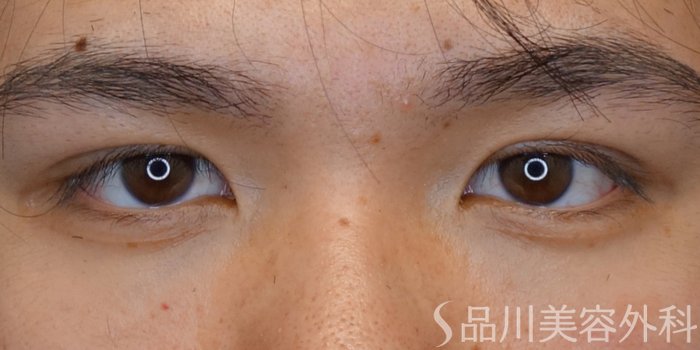 症例NO.69640のAFTER写真