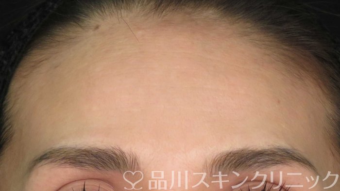 症例NO.71611のBEFORE写真