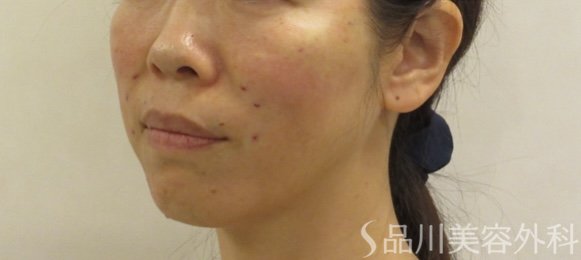 症例NO.72101のAFTER写真