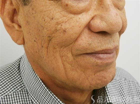症例NO.30975のBEFORE写真