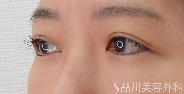 症例NO.62183のAFTER写真
