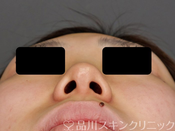 症例NO.75268のBEFORE写真