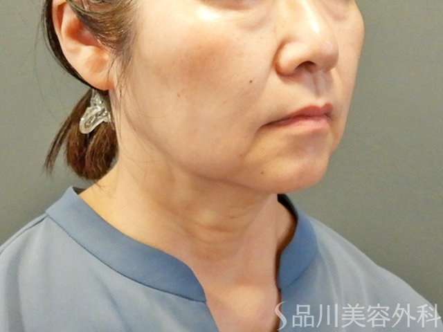 症例NO.67754のAFTER写真