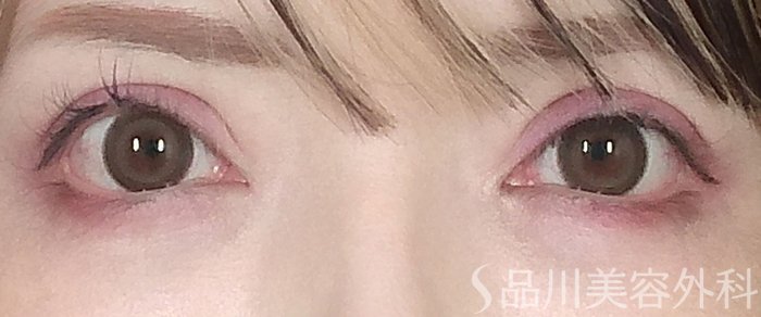 症例NO.64987のBEFORE写真