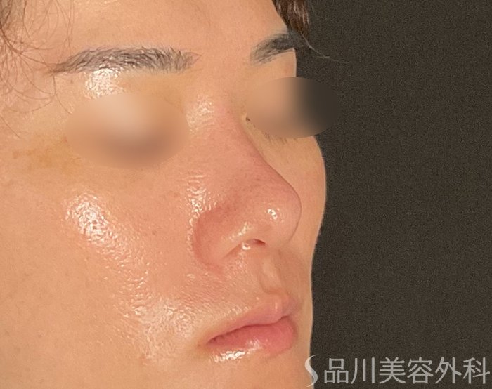 症例NO.74822のAFTER写真