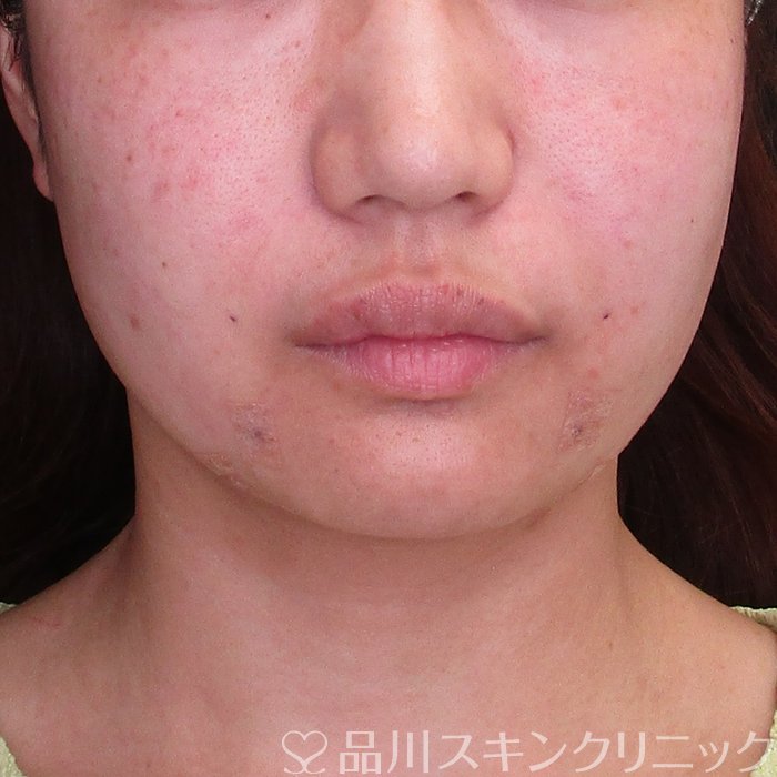 症例NO.74028のAFTER写真