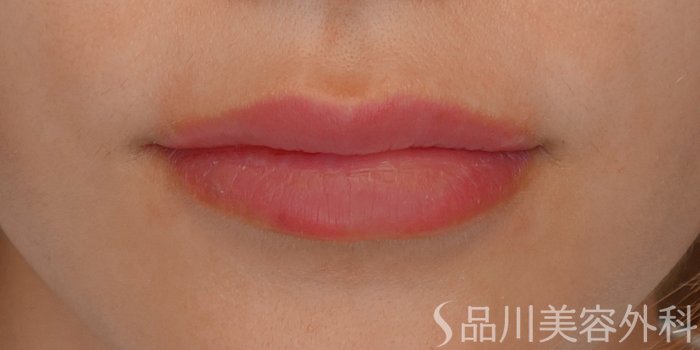 症例NO.71620のAFTER写真