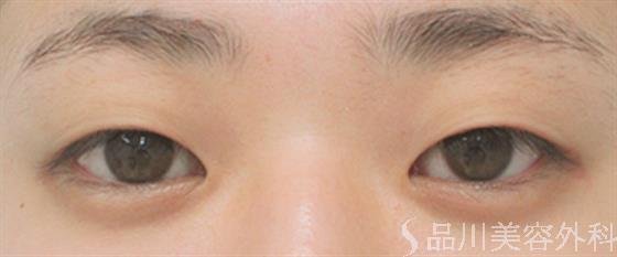 症例NO.24682のBEFORE写真