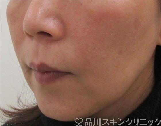 症例NO.41814のBEFORE写真