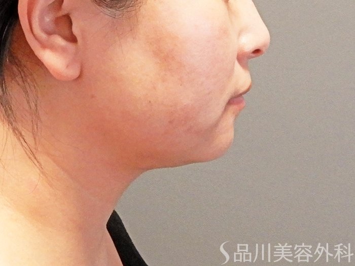 症例NO.63669のAFTER写真