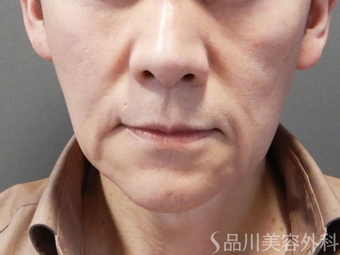 保険またはメディケアでカバーされますか?