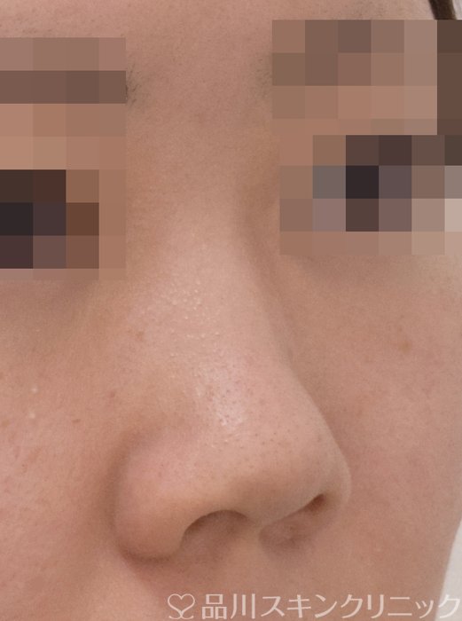 症例NO.71736のBEFORE写真