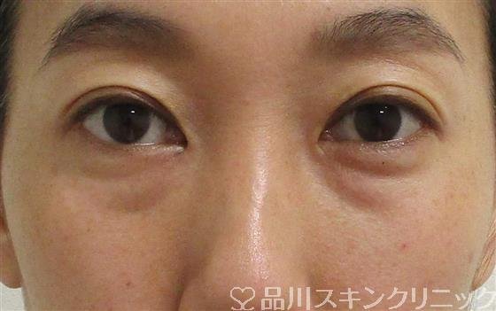 症例NO.61186のBEFORE写真