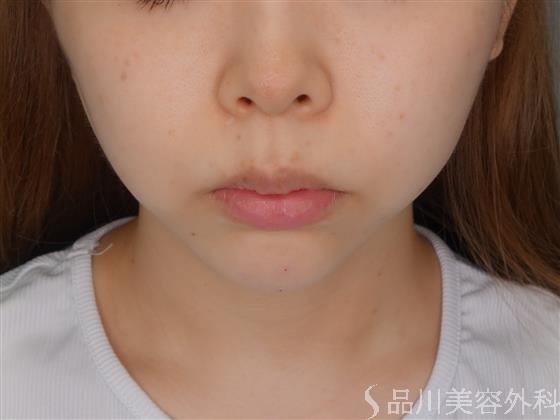 症例NO.51743のAFTER写真