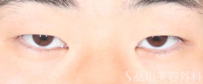 症例NO.72576のBEFORE写真