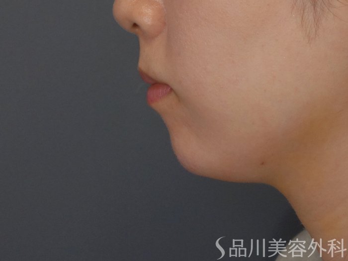 症例NO.65447のAFTER写真