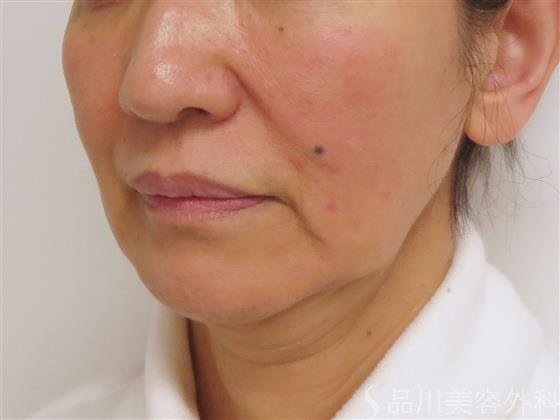 症例NO.46264のBEFORE写真