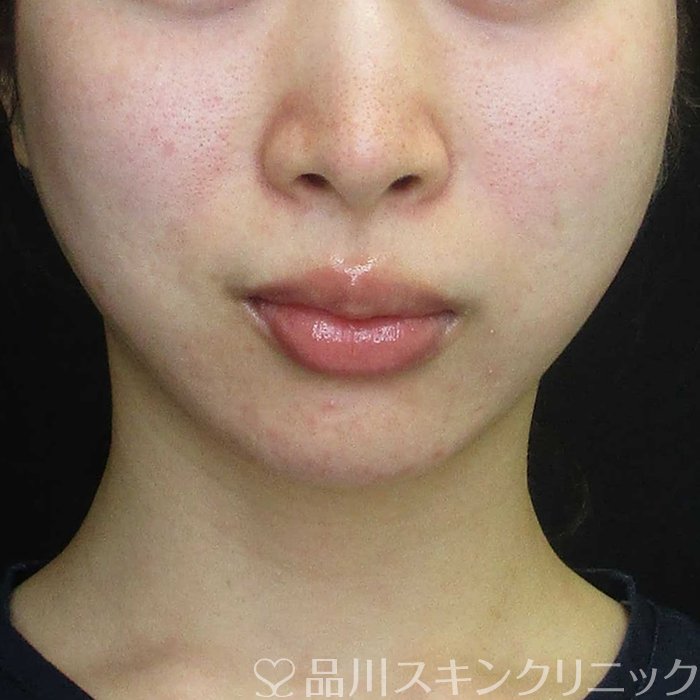 症例NO.70225のAFTER写真