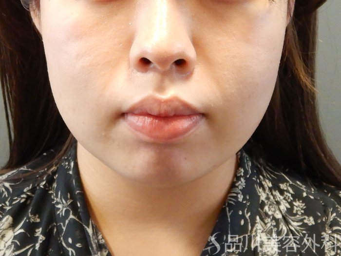 症例NO.62168のBEFORE写真