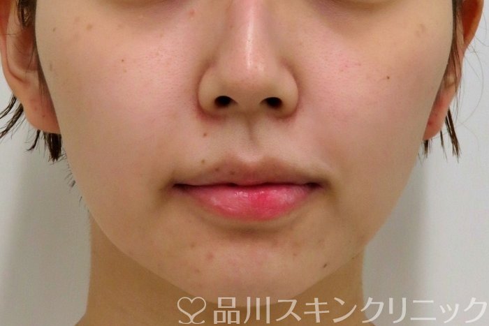 症例NO.74085のBEFORE写真